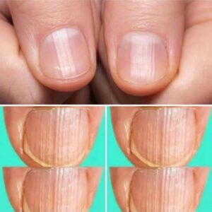 Tener uñas rayadas podría significar que… Tener uñas rayadas podría significar que…